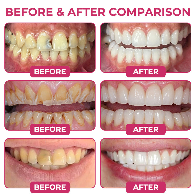 Harrigarri DenPerm Enamel Repair Gel – Helps Strengthen Enamel & Reduce Tooth Sensitivity