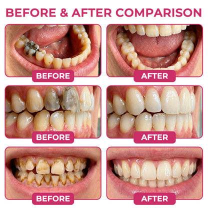 Harrigarri DenPerm Enamel Repair Gel – Helps Strengthen Enamel & Reduce Tooth Sensitivity